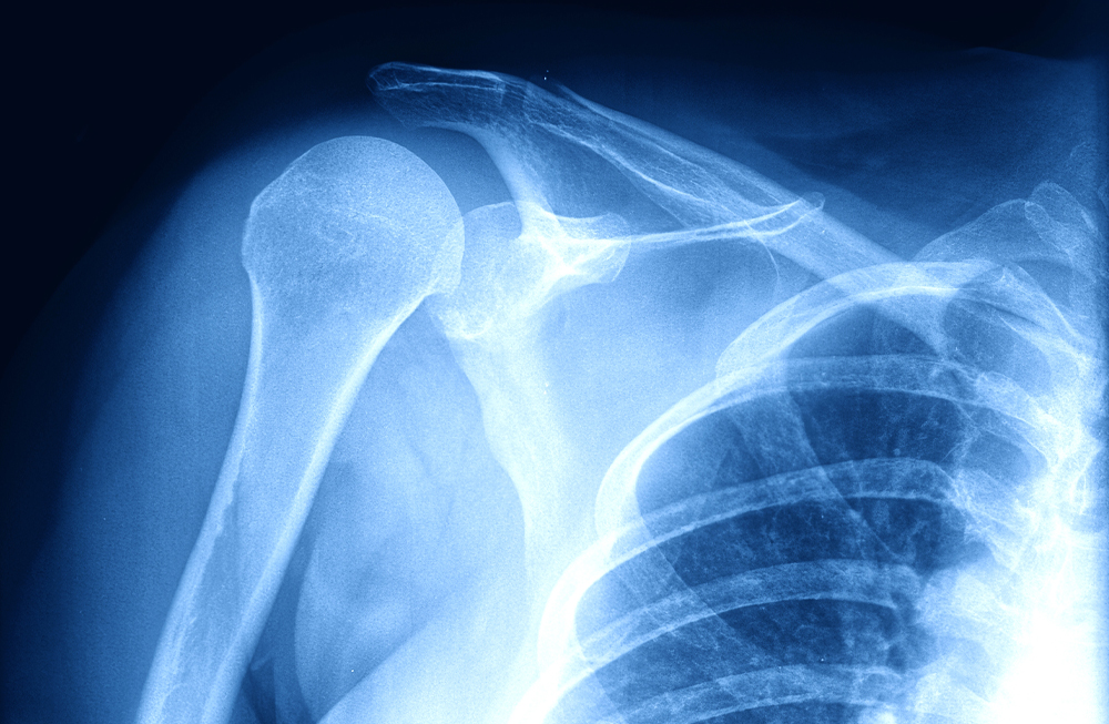 X ray of shoulder
